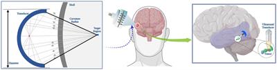 A transducer positioning method for transcranial focused ultrasound treatment of brain tumors